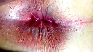 Irritant together with anus closeup